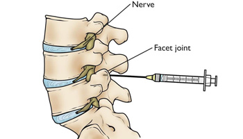 Facet Joint Injection