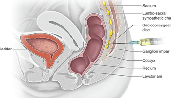 Ganglion Impar Injection