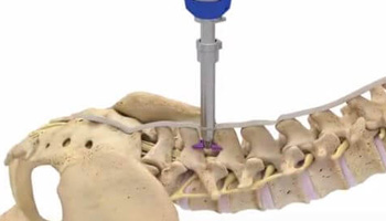 Lumbar Indirect Decompression