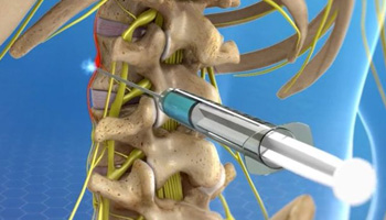 Lumbar Sympathetic Nerve Block