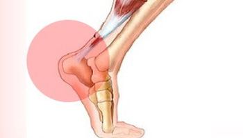 Percutaneous Tenotomy