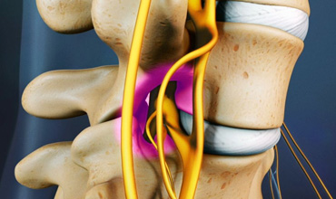 Sciatica Pain